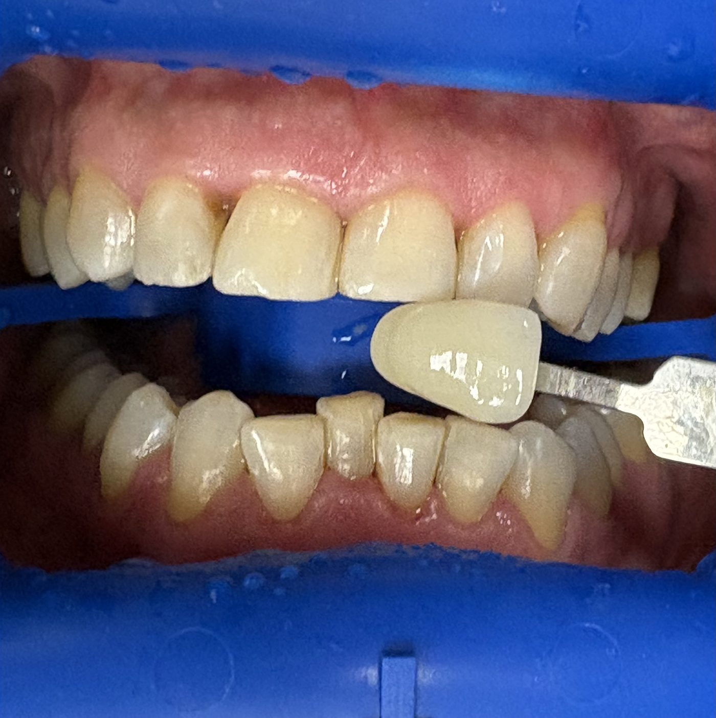 Comparație nuanță dentară față de culoarea naturală după albire Zoom